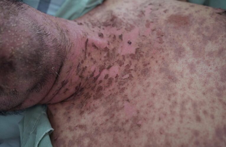 Cảnh báo dị ứng thuốc nghiêm trọng do dùng thuốc không rõ nguồn gốc